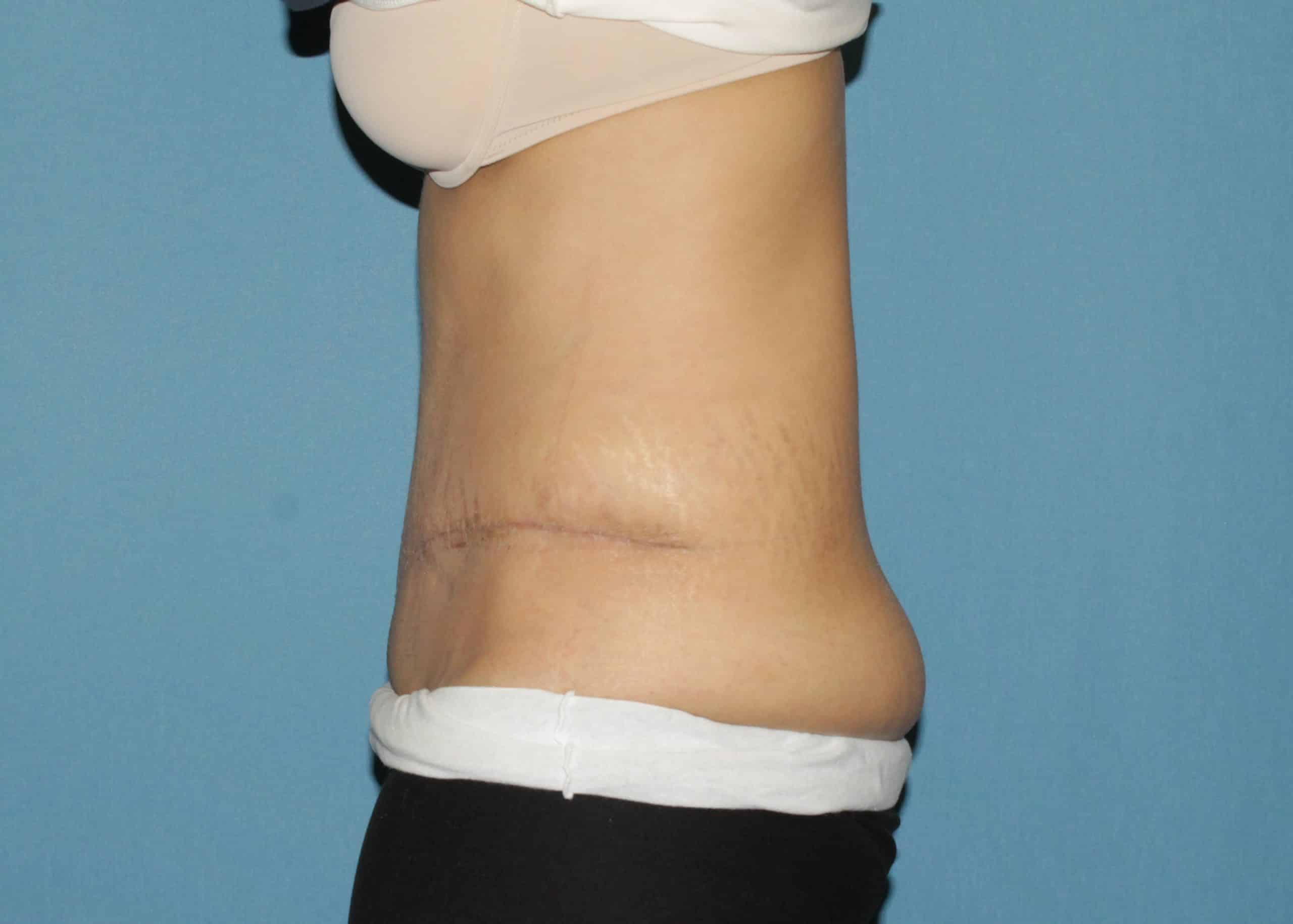 Tummy Tuck Before and After Pictures in Cape Girardeau