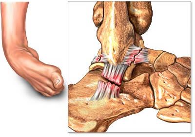 How Long Does A Torn Ligament Take To Heal In Foot saintjohn