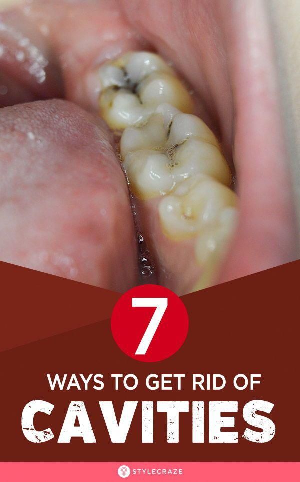 How To Get Rid Of Cavities Without Fillings All