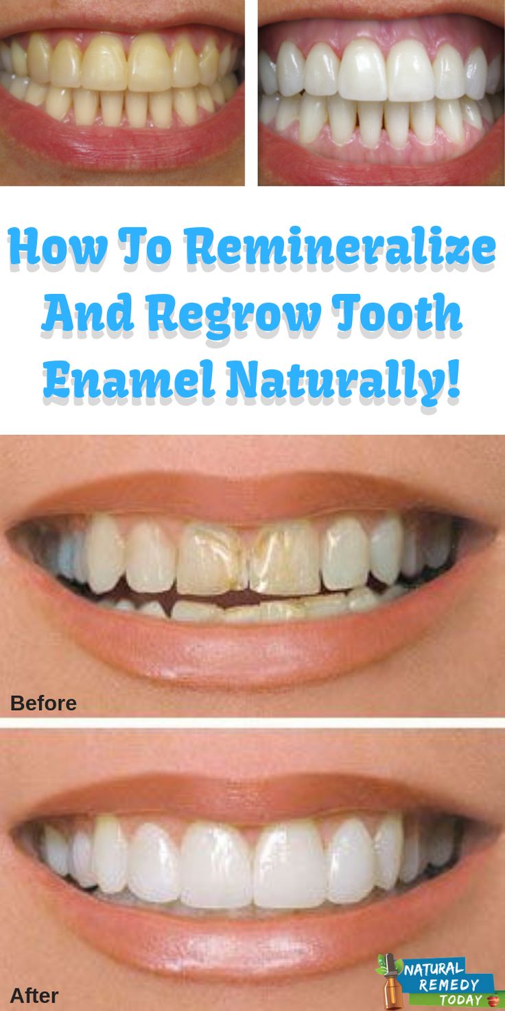 How To Restore Tooth Enamel Naturally Best Ideas 2021
