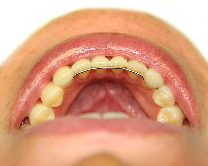 My lower fixed retainer came out, what should I do? Ask