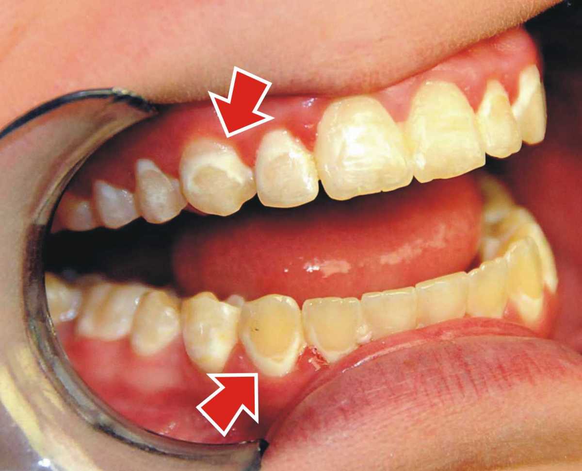 How Do You Treat White Spots After Braces? Ask an