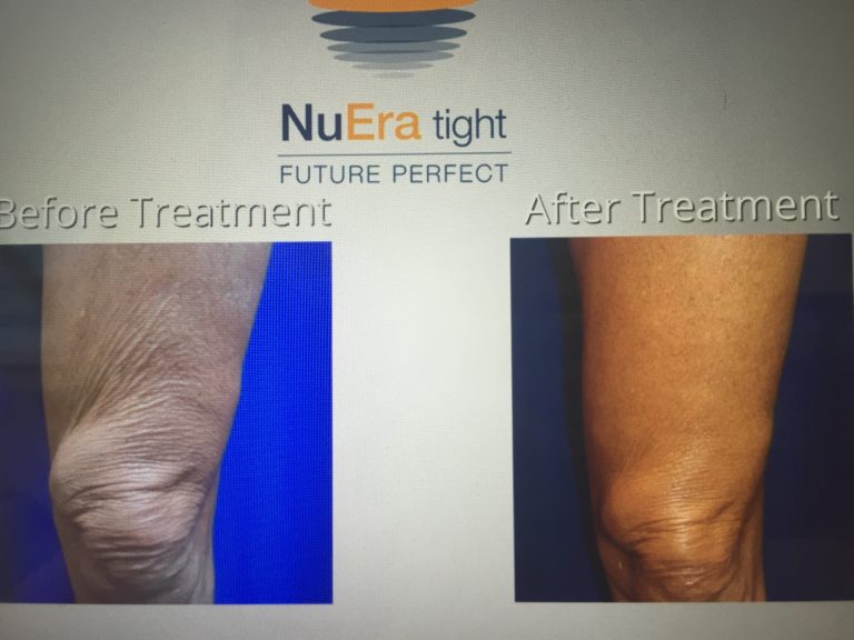 Skin tightening Radio Frequency Azani Medical Spa