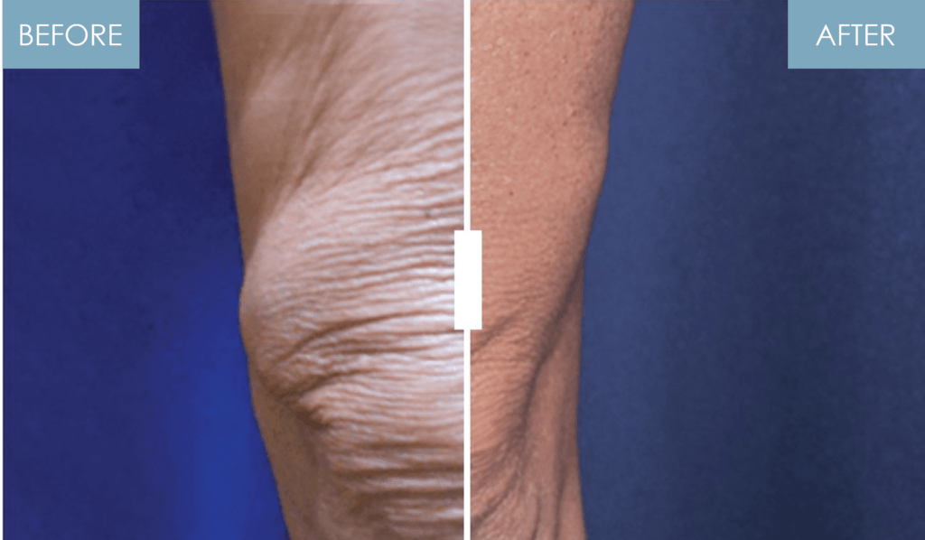 Skin Tightening Azani Medical Spa