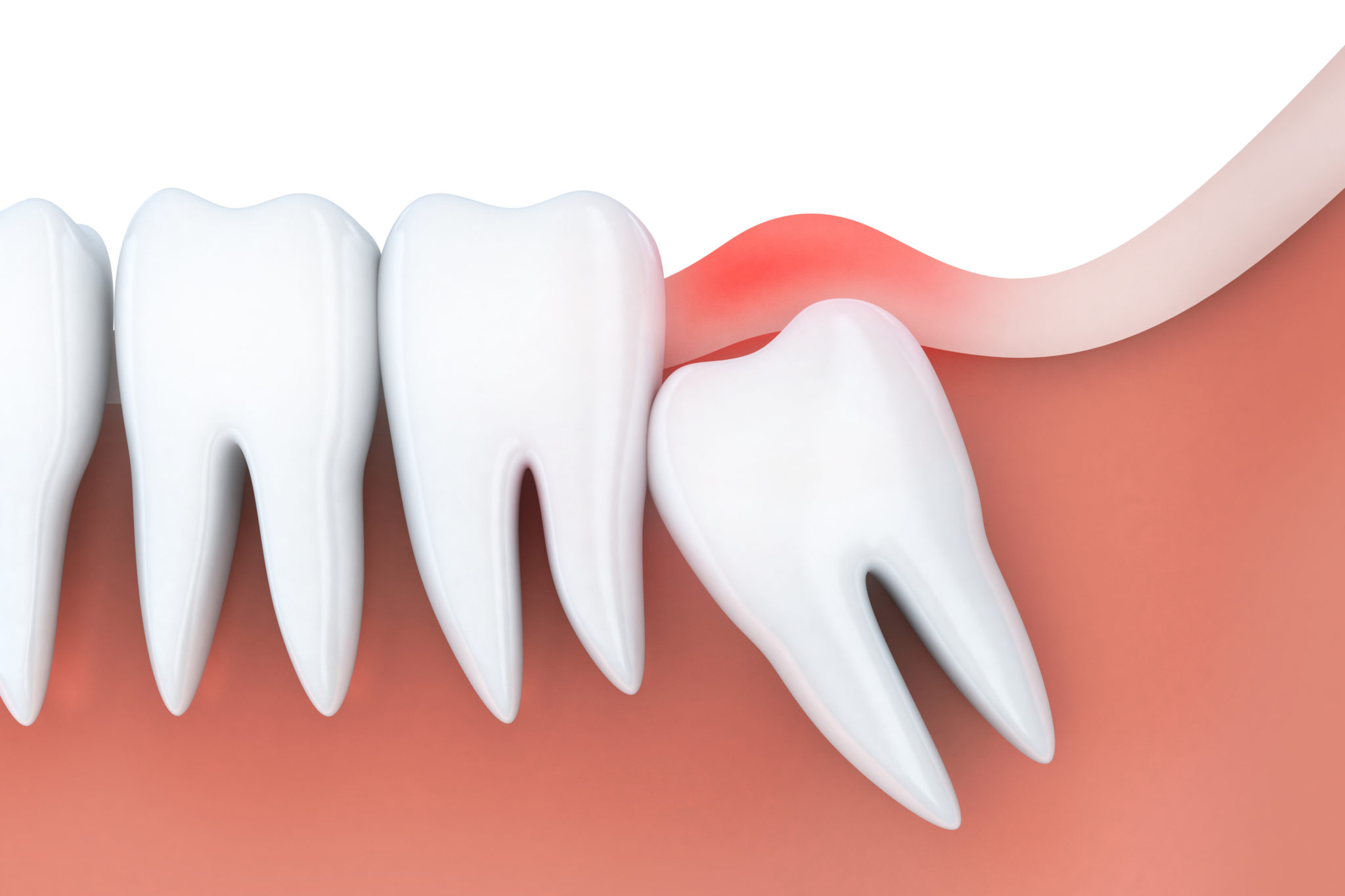 How Long Does A Tooth Extraction Take To Heal at Craigslist