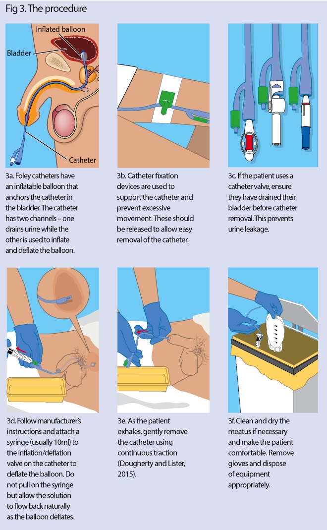 Urinary catheters 6 removing an indwelling urinary