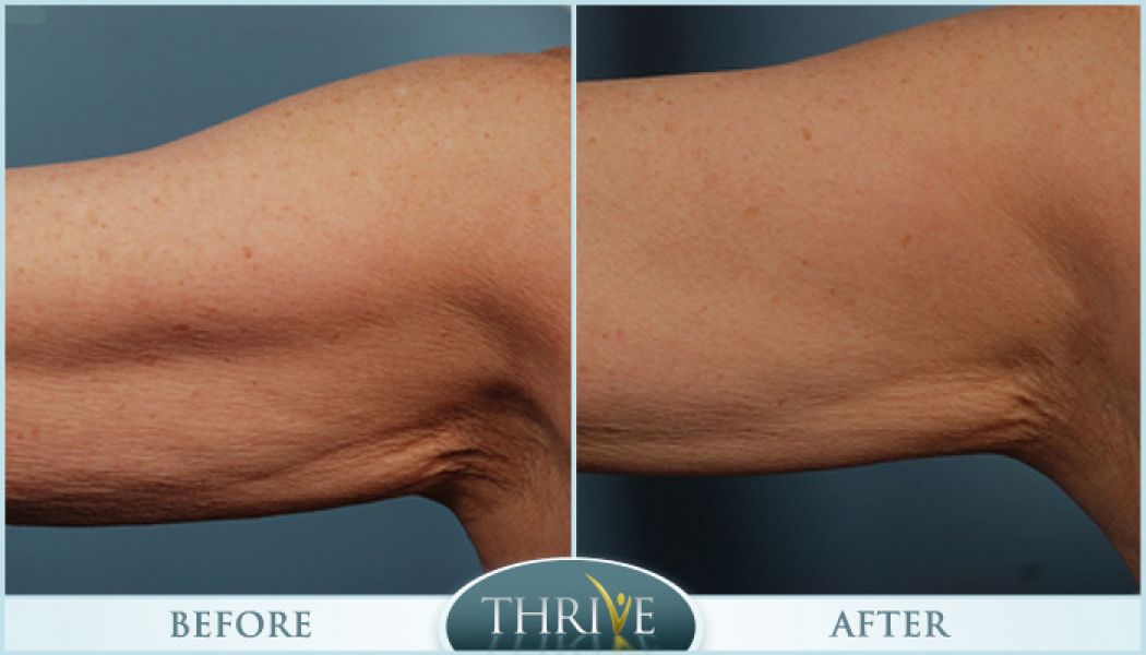 Lift And Tighten Skin in Portland