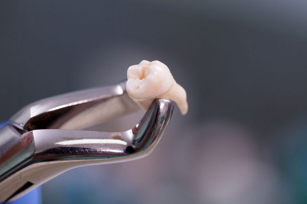 How Long Does Wisdom Teeth Removal Take To Heal Reddit Amaze