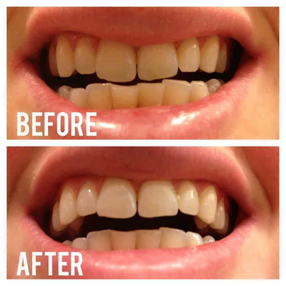 How To Whiten Teeth With Hydrogen Peroxide Boston