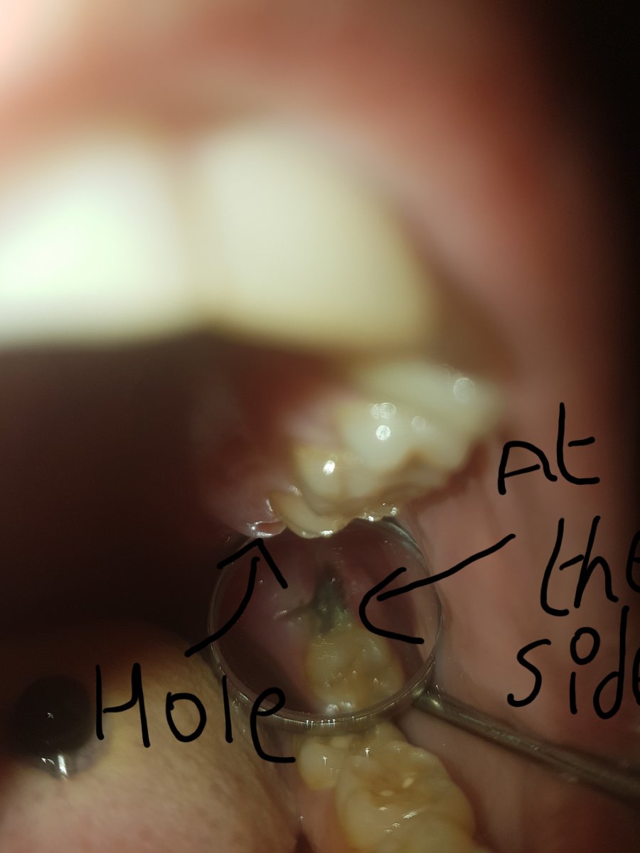How Long Does Wisdom Teeth Removal Take To Heal Reddit Amaze
