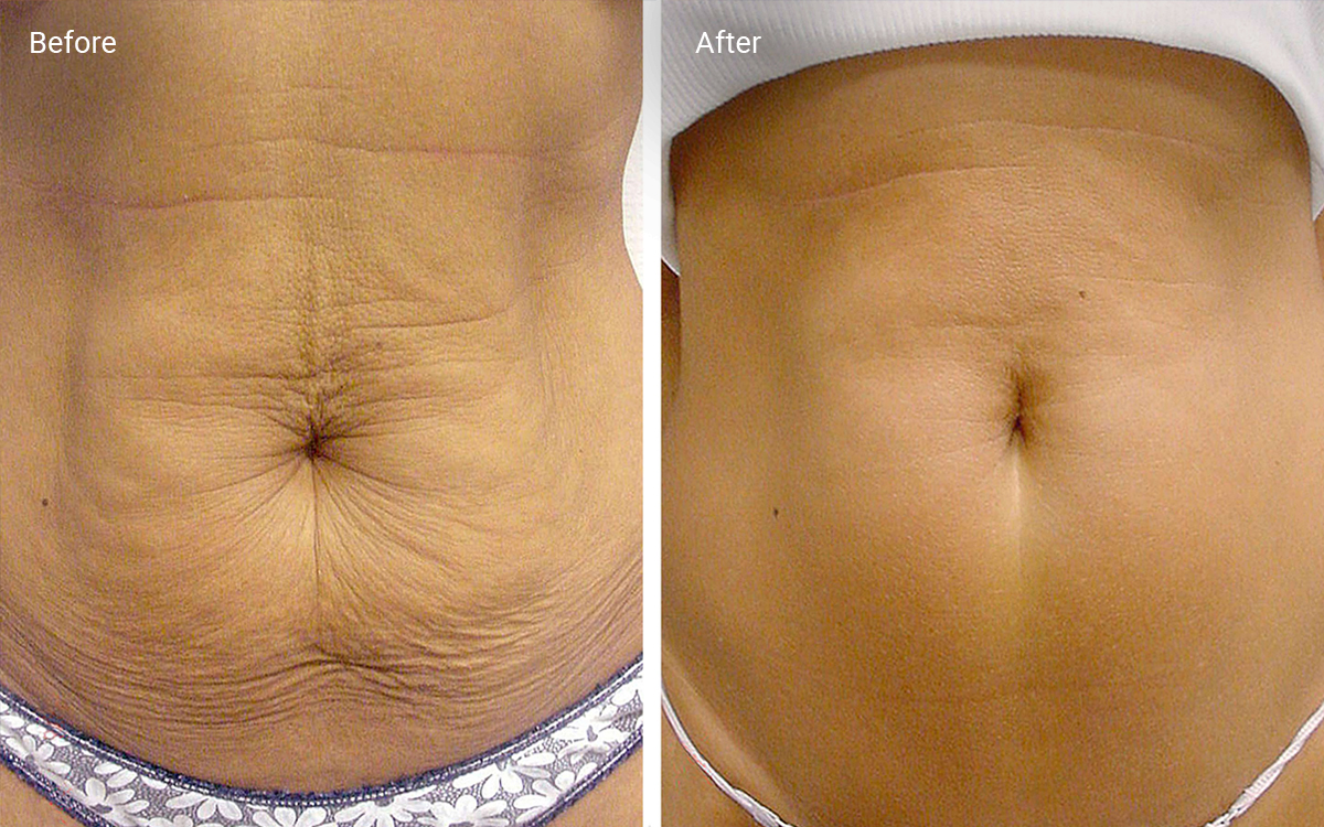 Laser Skin Tightening How It Works, Results, Risks and Cost