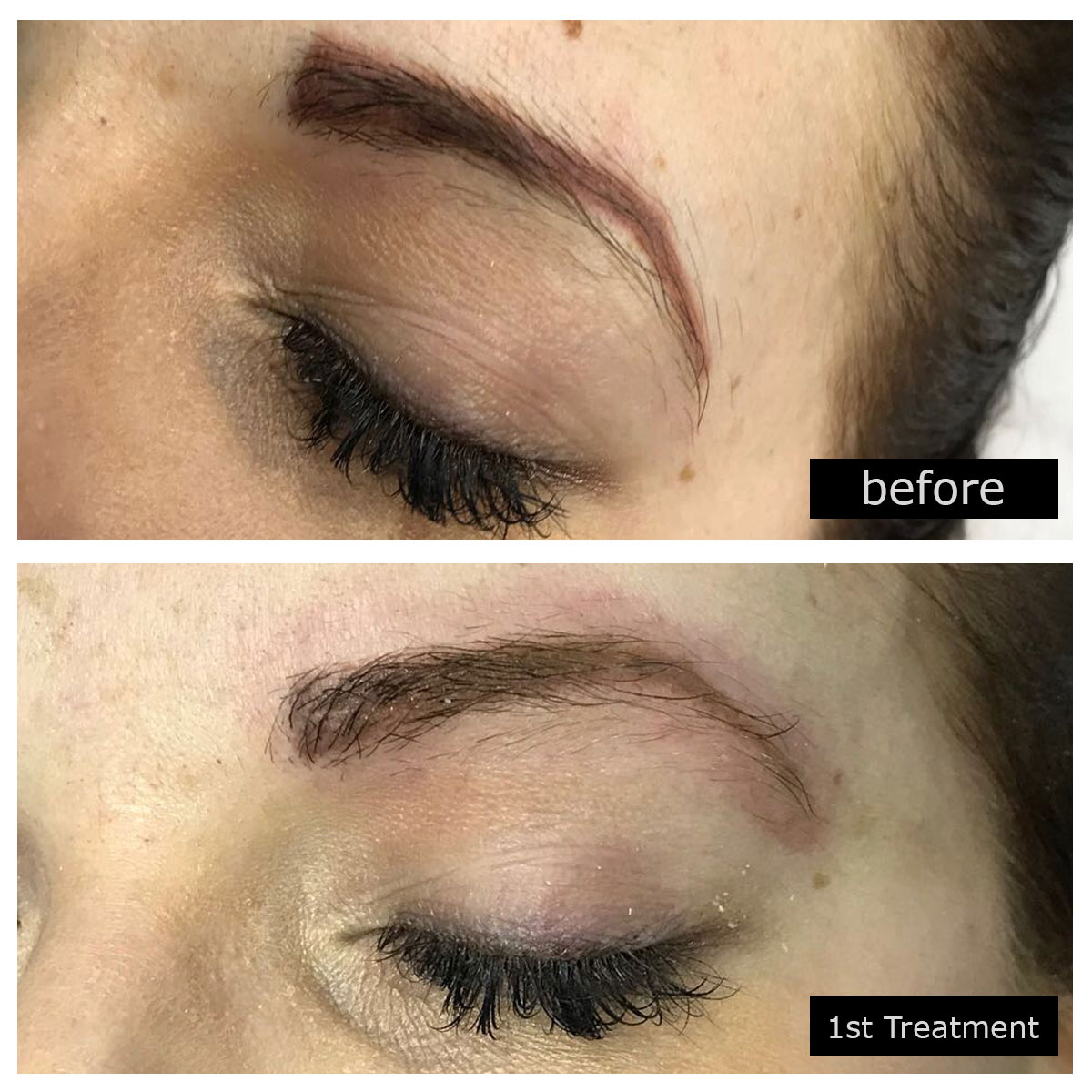 Microblading Removal Treatments in Birmingham PhiRemoval