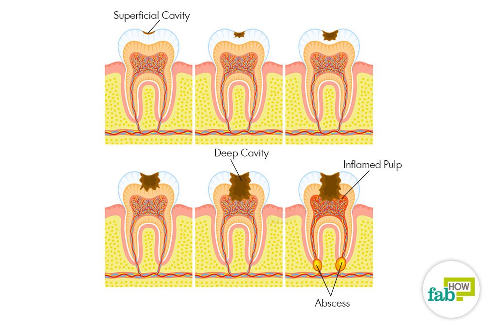 How to Get Rid of Cavities and Heal Tooth Decay Fab How