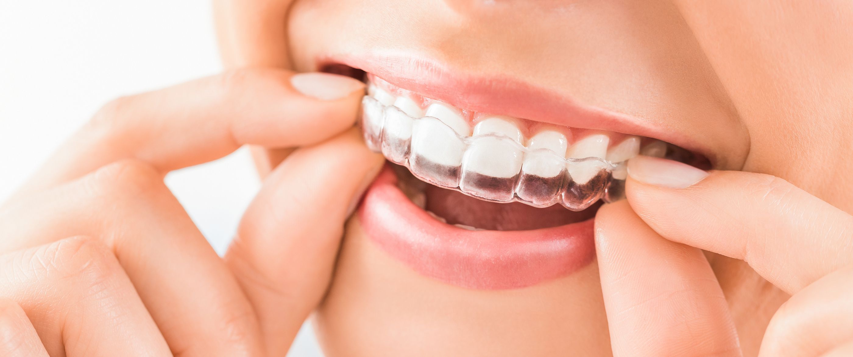 After Invisalign How Many Hours a Day Will I Need to Wear
