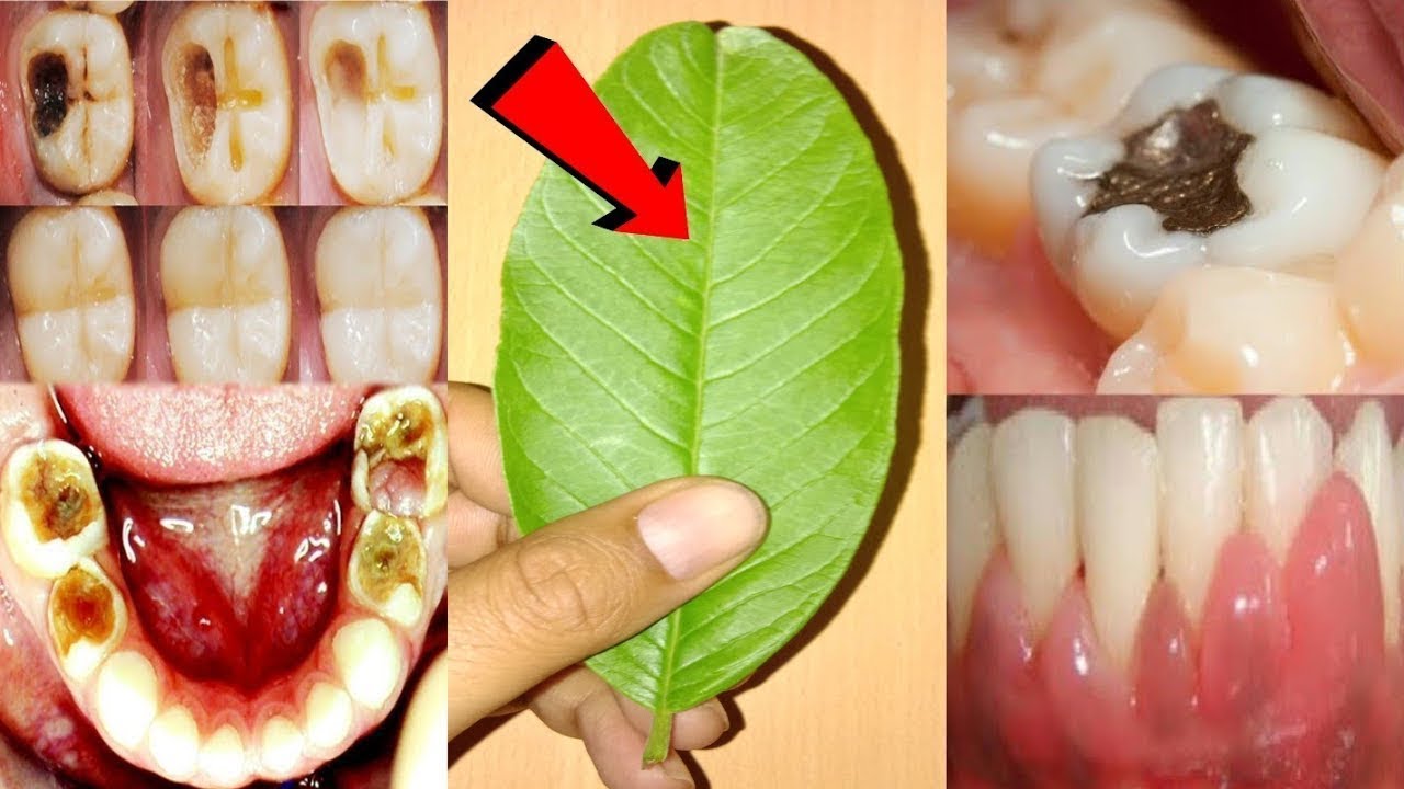 How to get rid of teeth cavities teeth cavity