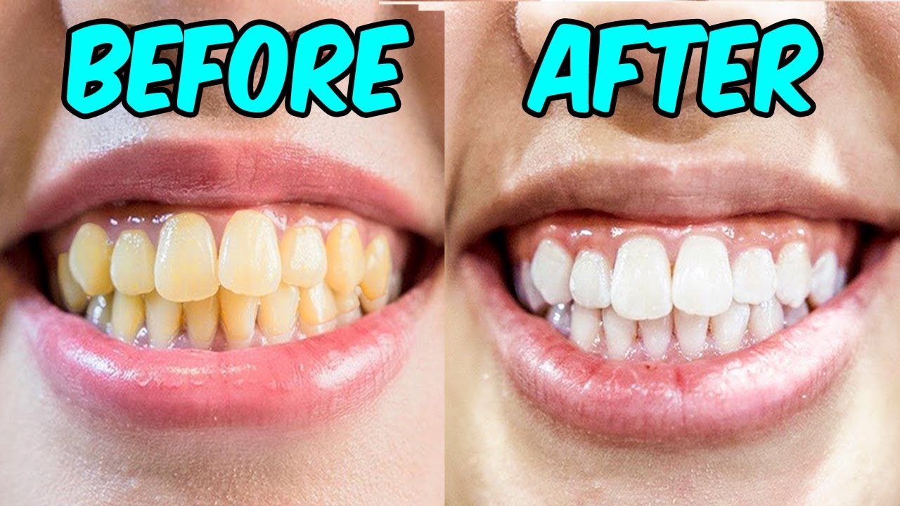 How To Whiten Your Teeth With Hydrogen Peroxide (Baking