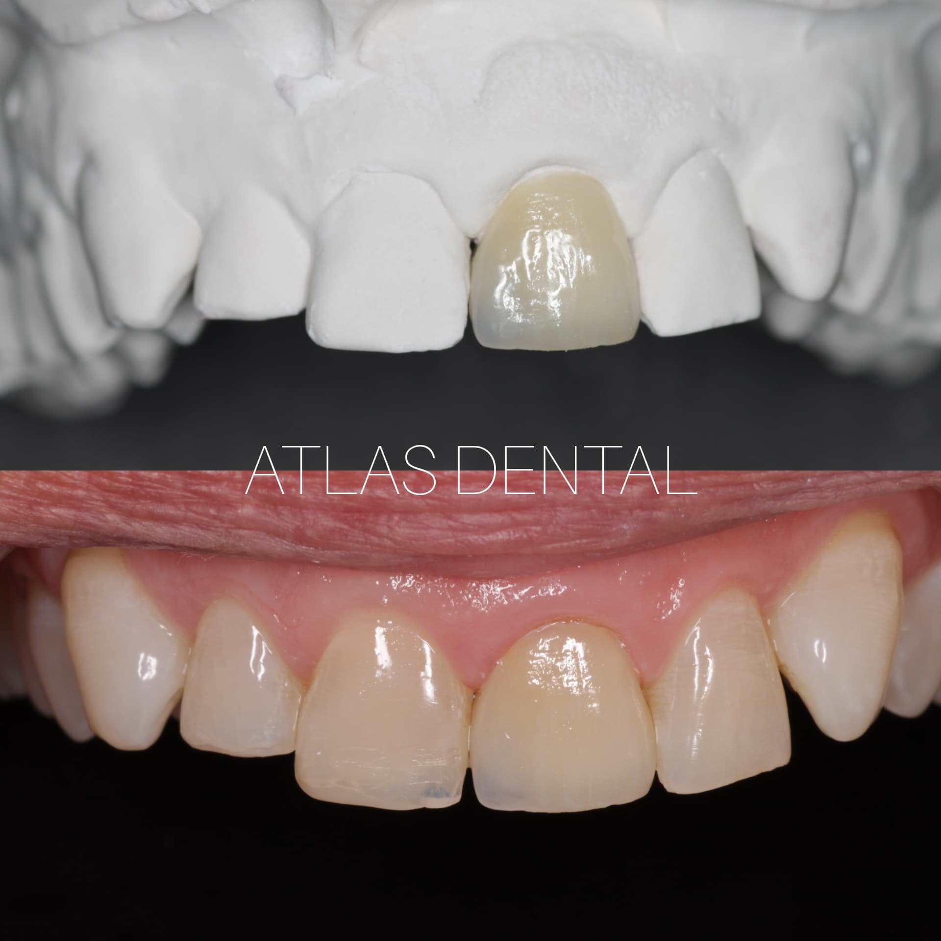 How To Get Rid Of Cavities Without Fillings Zarkmercs