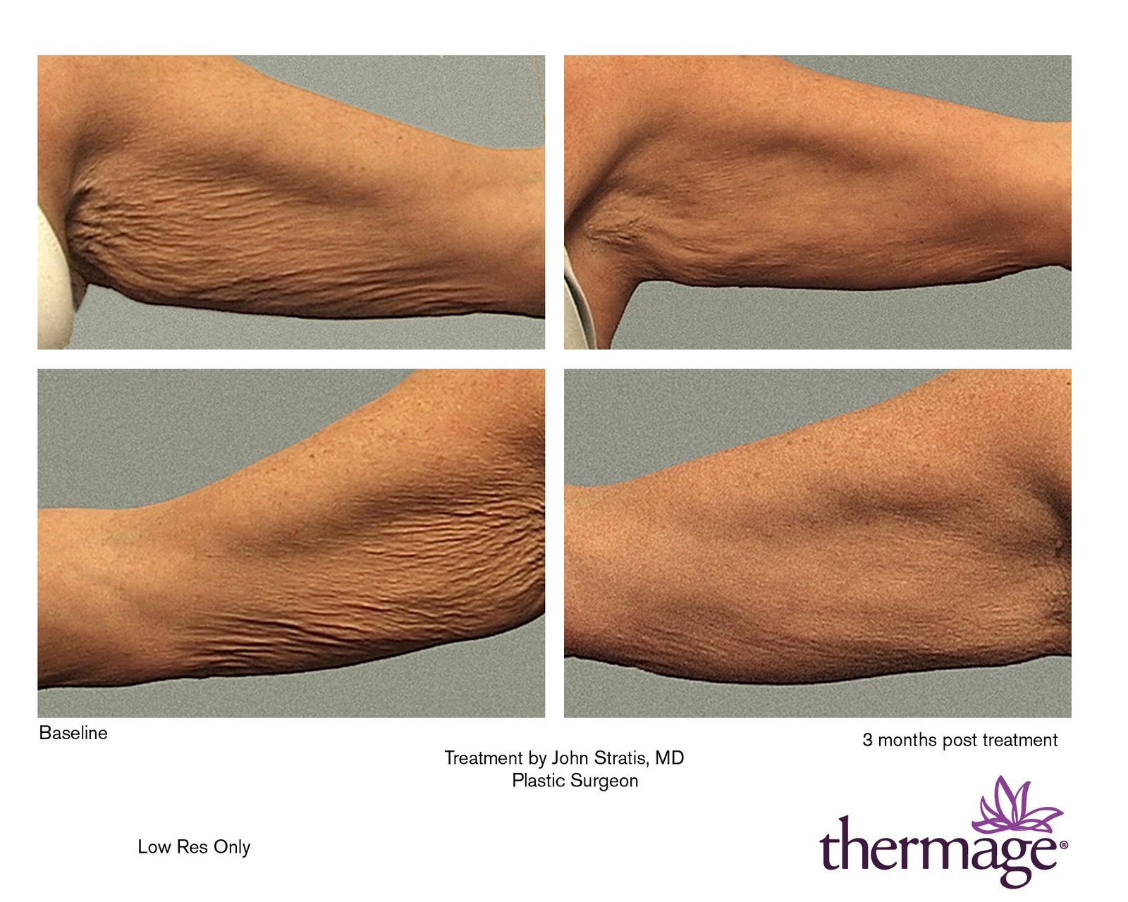 Thermage skin tightening on the Face, Arms, Thighs