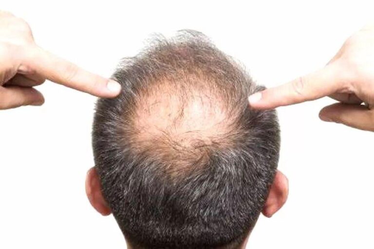 Probiotics may slow or even reverse hair loss Medical News