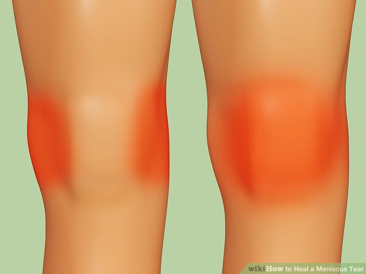 How Do I Know If My Knee Sprain Is Healed Duane Pickrell