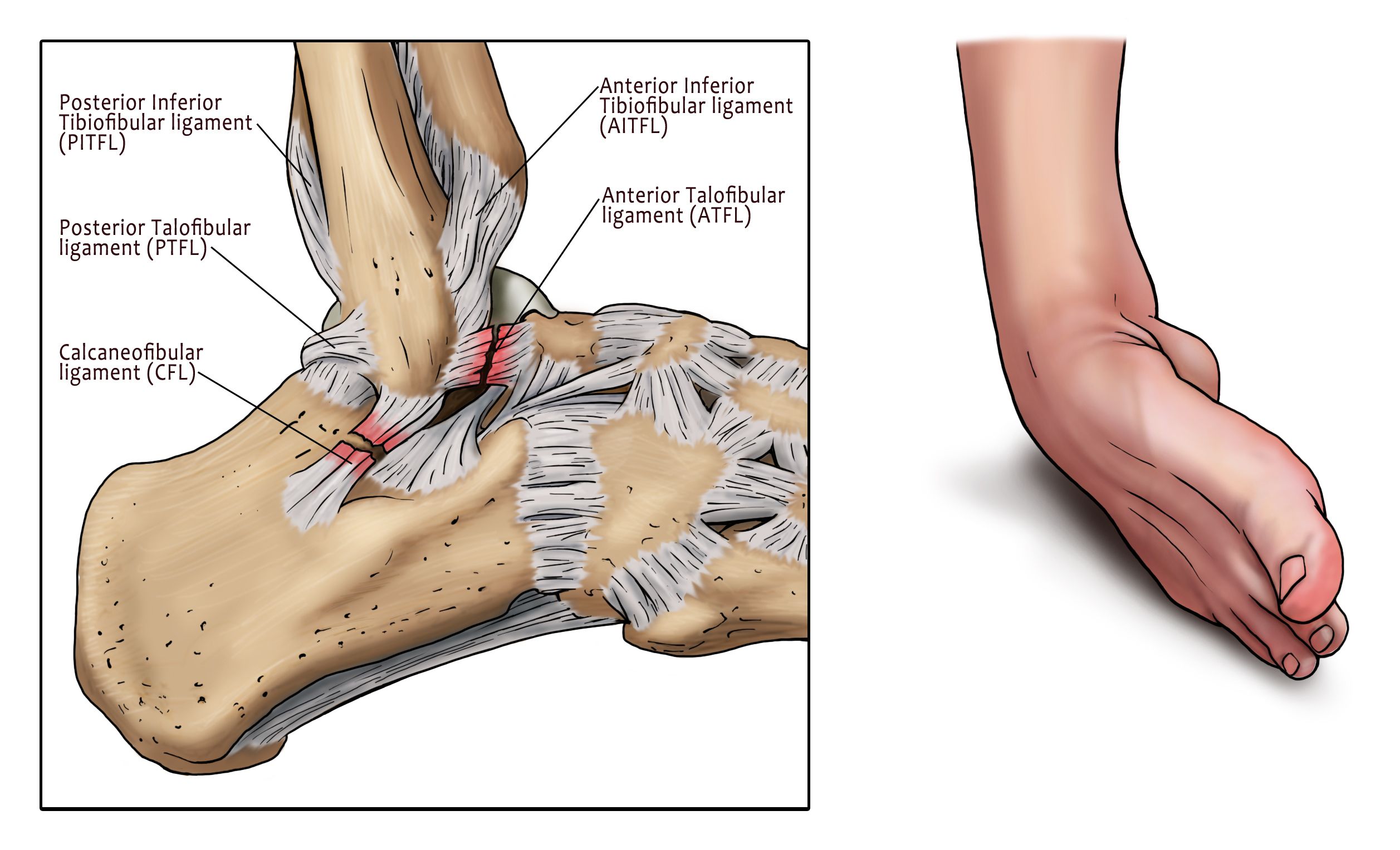 How Long Does A Torn Ligament Take To Heal In Foot saintjohn