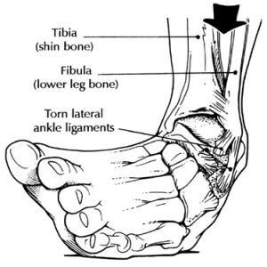 How Long Does Take For A Sprained Ankle To Heal saintjohn