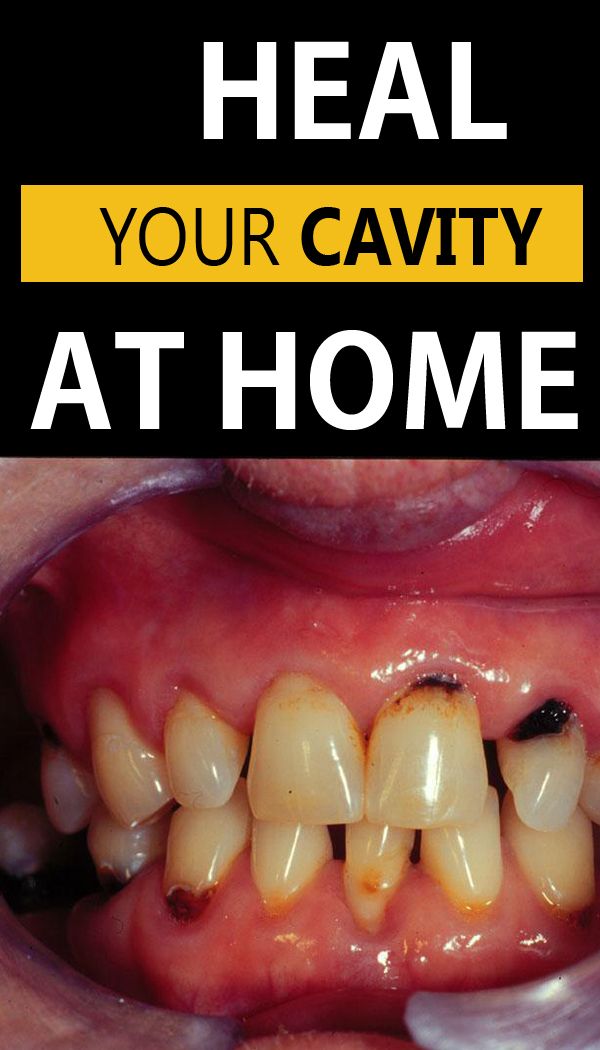 How To Heal a Cavity Without Fillings A Fit Life Style