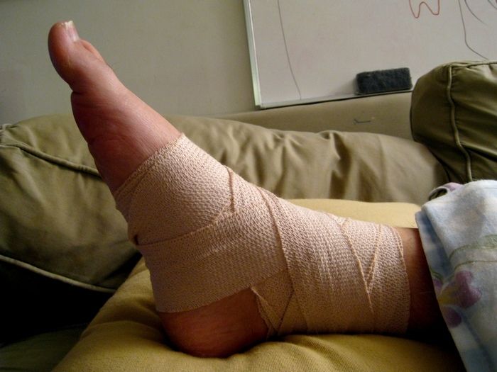 How Long Does a Sprained Ankle Take to Heal? Sprained