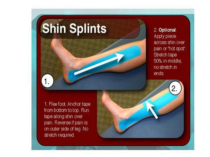 Shin splints with Terra tape Shin splints, Shin splints