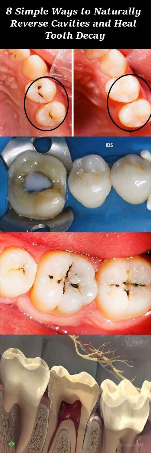how to heal a cavity without fillings how to heal