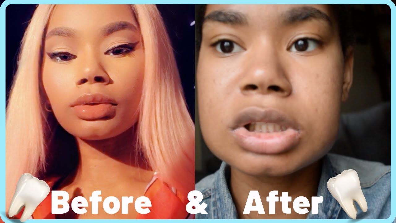How Long Does It Take For Teeth To Grow Back After Tooth