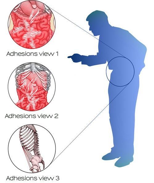 How To Break Up Adhesions After Knee Replacement saintjohn
