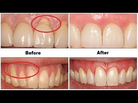 How Long Does It Take For My Teeth To Grow Back saintjohn