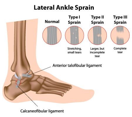 How Long Does A Torn Ligament Take To Heal In Foot saintjohn