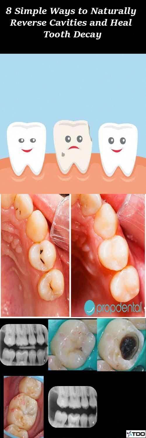 how to heal a cavity without fillings
