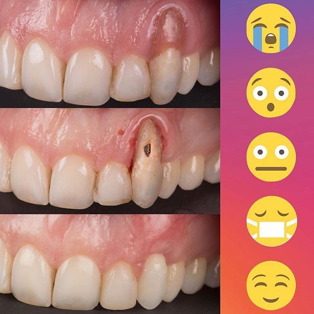 Correcting a gum recession. Removal of old pink composite
