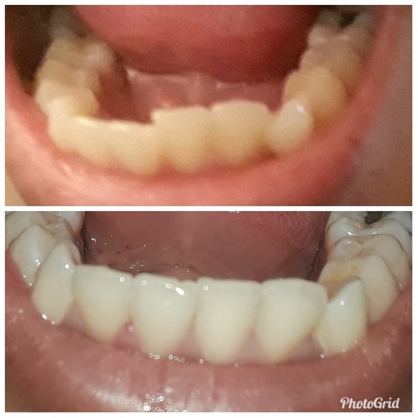 Can my old retainer straighten back my teeth? Quora