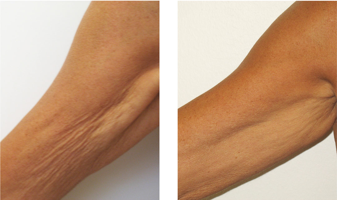 Minimally Invasive Plastic Surgery Rosenberg Plastic Surgery