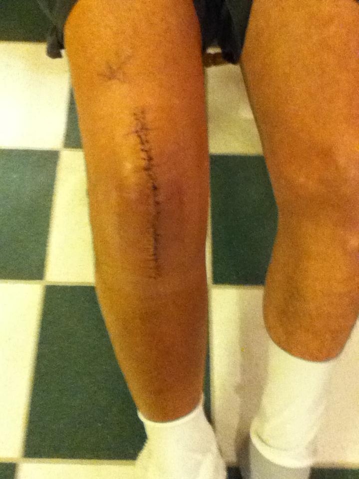 After one week. Knee Replacement Scars Pinterest