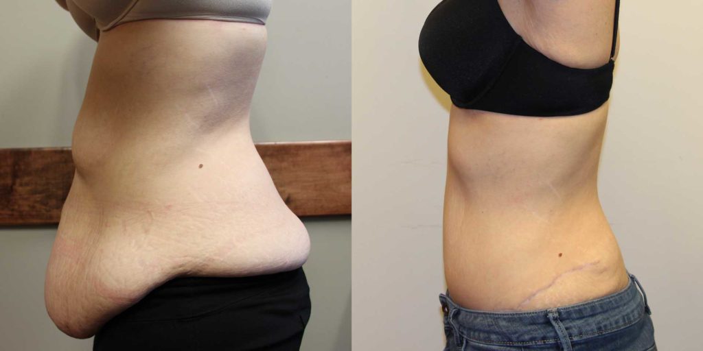 Tummy Tuck After Weight Loss Blog Titles TIAFT