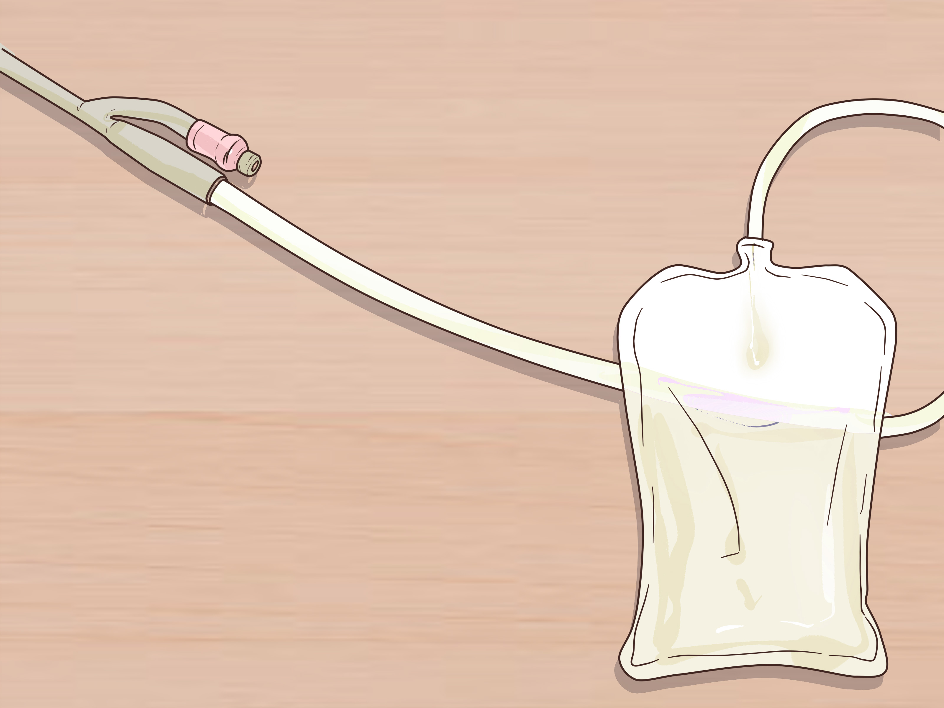 Einen Foley Katheter spülen (mit Bildern) wikiHow