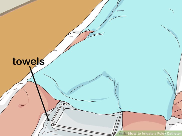 How to Irrigate a Foley Catheter (with Pictures) wikiHow