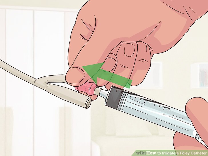 How to Irrigate a Foley Catheter (with Pictures) wikiHow