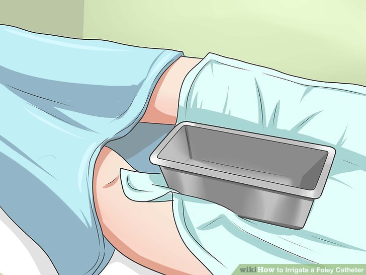How to Irrigate a Foley Catheter (with Pictures) wikiHow