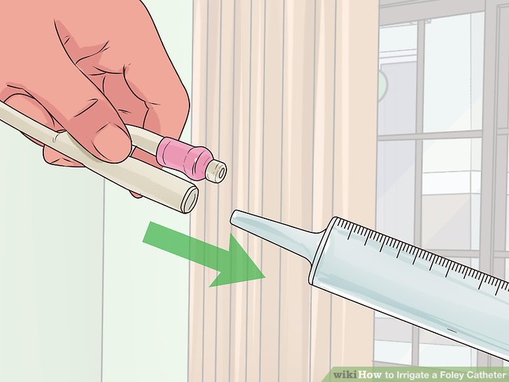 How to Irrigate a Foley Catheter (with Pictures) wikiHow