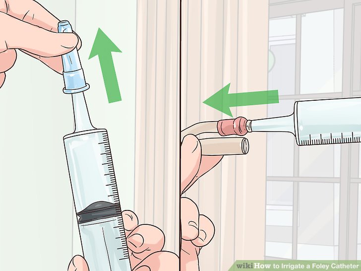 How to Irrigate a Foley Catheter (with Pictures) wikiHow