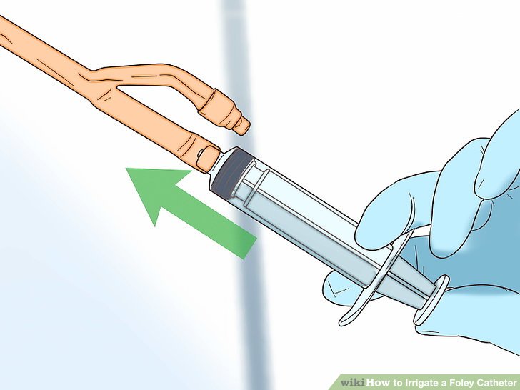 How to Irrigate a Foley Catheter (with Pictures) wikiHow