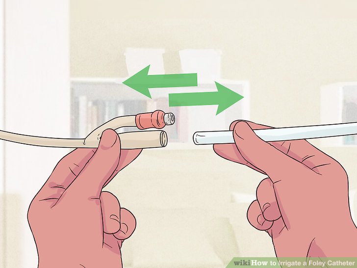 How to Irrigate a Foley Catheter (with Pictures) wikiHow